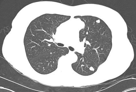Lung Metastasis CT Chest